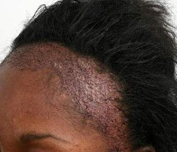 traction alopecia